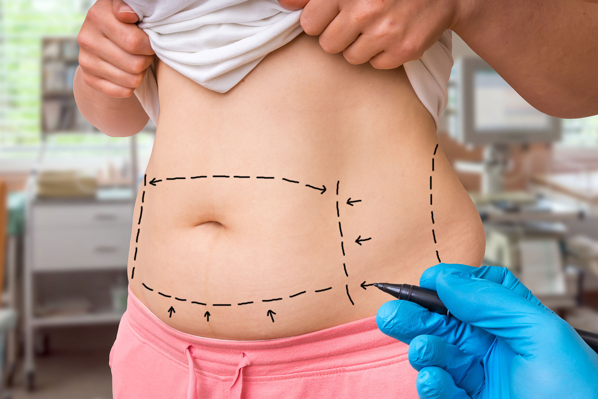 Tummy Tuck